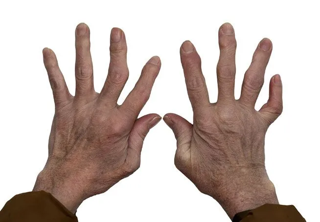 Hand and Finger Arthritis