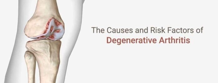 Degenerative Arthritis