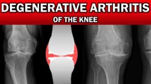 Degenerative Arthritis of the Knee