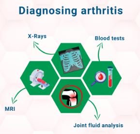 Diagnosing Arthritis