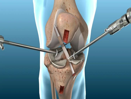 ACL Injury in young athletes
