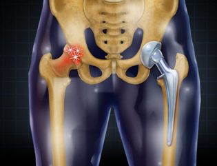 Hip Replacement in Delhi