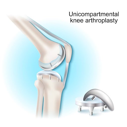 Best Elbow Arthritis Surgeon in Delhi